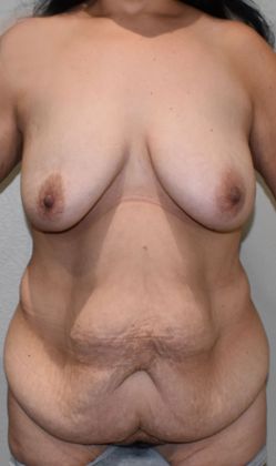 Mommy Makeover Case 212 - Before