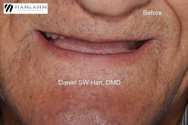 Full Mouth Reconstruction Case 9 - Before