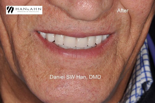 Full Mouth Reconstruction Case 9 - After