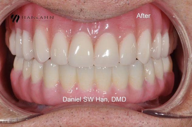 Full Mouth Reconstruction: Case 9 - Max and Mand Implant Supported hybrids