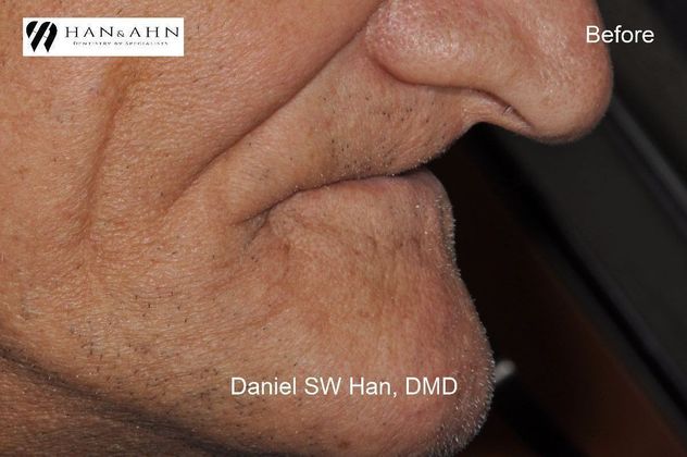 Full Mouth Reconstruction: Case 9 - Before