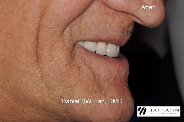 Full Mouth Reconstruction: Case 9 - After