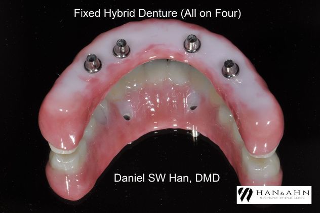 Full Mouth Reconstruction: Case 9 - Abutment Connection