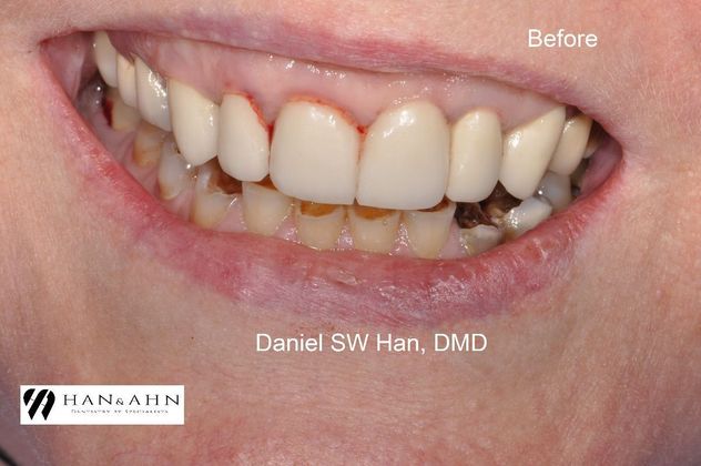 Full Mouth Reconstruction Case 10 - Before