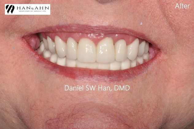 Full Mouth Reconstruction Case 10 - After