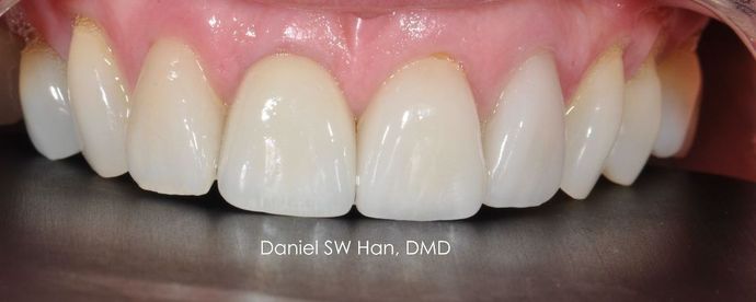 Cosmetic Dentistry: Case 4 - After