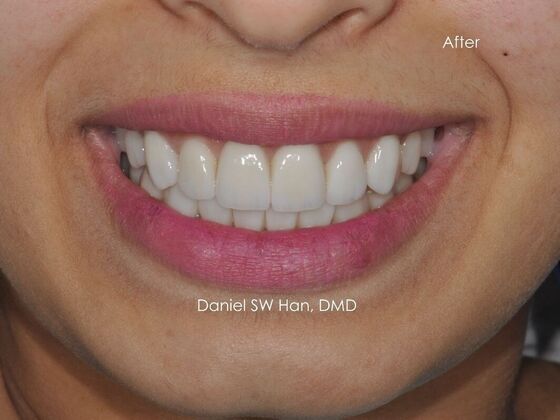 Cosmetic Dentistry: Case 5 - After