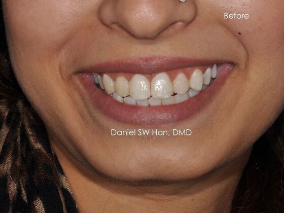 Cosmetic Dentistry: Case 5 - Before