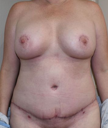 Mommy Makeover Case 213 - After