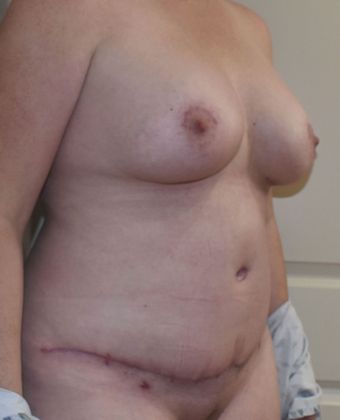 Mommy Makeover: Case 213 - After