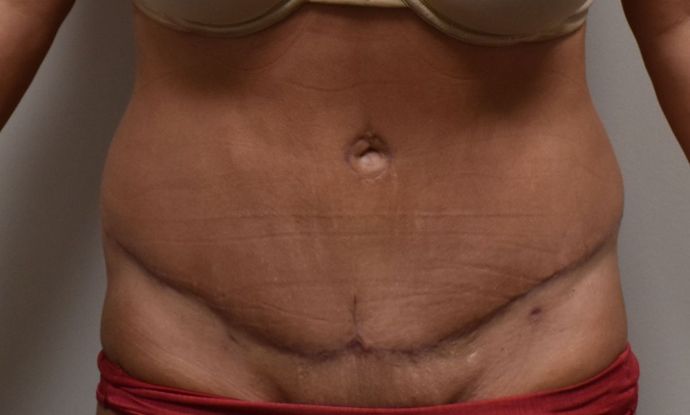 Tummy Tuck (Abdominoplasty): Case 313 - After