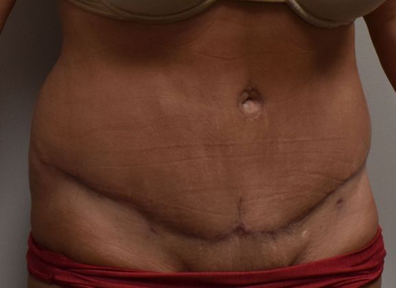 Tummy Tuck (Abdominoplasty): Case 313 - After