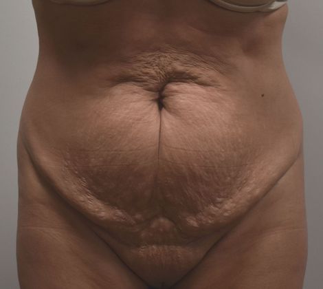Tummy Tuck (Abdominoplasty): Case 313 - Before