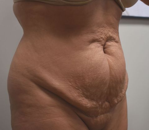 Tummy Tuck (Abdominoplasty): Case 313 - Before