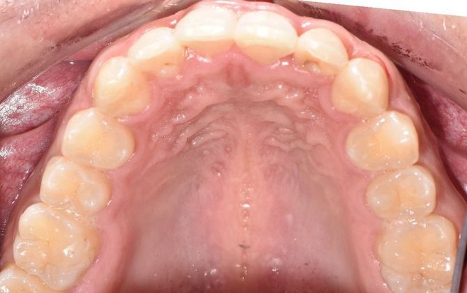 Straight teeth after using Invisalign