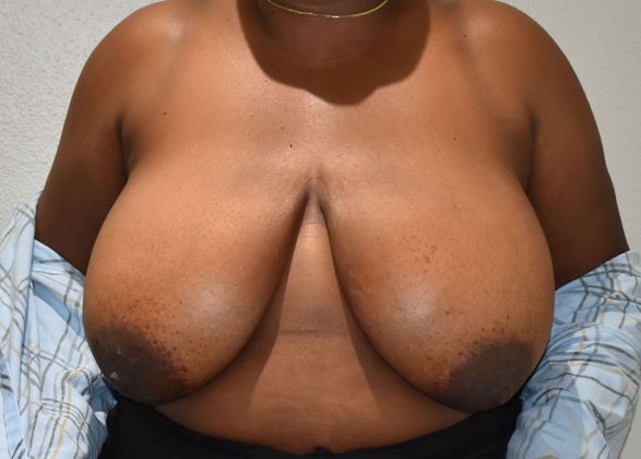 Breast Reduction Case 123 - Before
