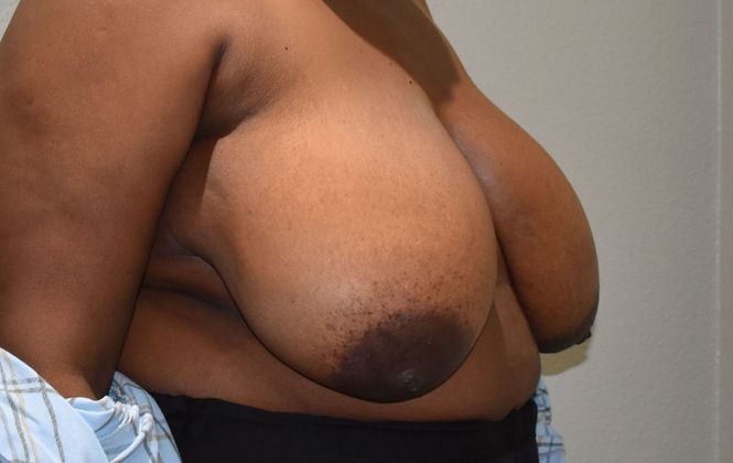 Breast Reduction: Case 123 - Before