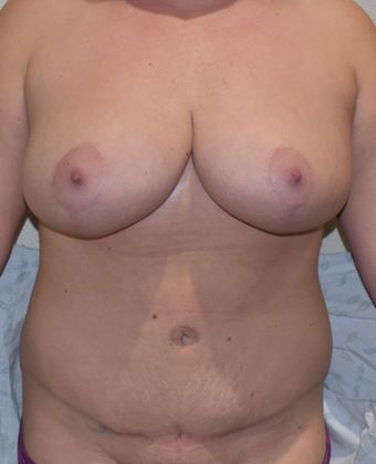 Mommy Makeover Case 215 - After