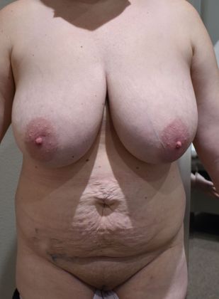 Mommy Makeover Case 215 - Before