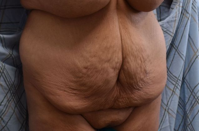 Tummy Tuck (Abdominoplasty): Case 315 - Before