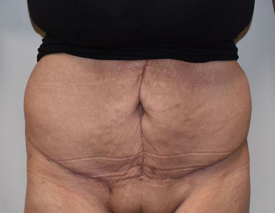Tummy Tuck (Abdominoplasty): Case 315 - After