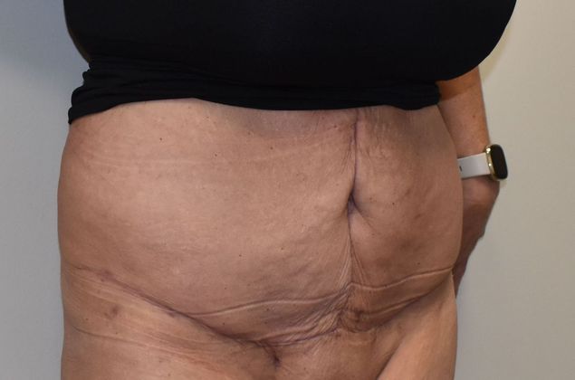 Tummy Tuck (Abdominoplasty): Case 315 - After