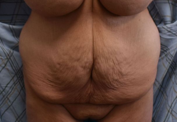 Massive Weight Loss : Case 90 - Before