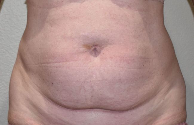 Tummy Tuck (Abdominoplasty): Case 316 - Before