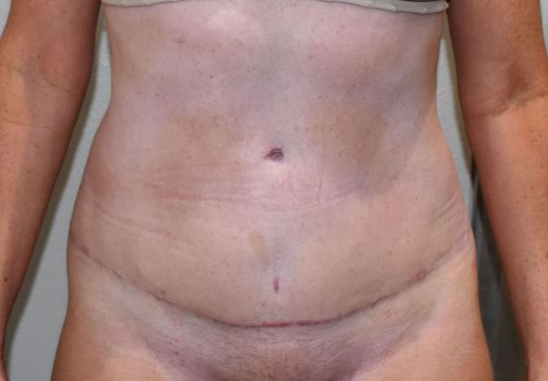 Tummy Tuck (Abdominoplasty): Case 316 - After