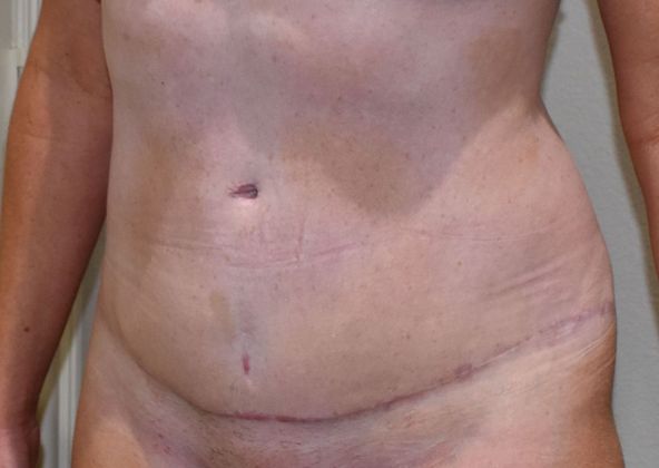Tummy Tuck (Abdominoplasty): Case 316 - After