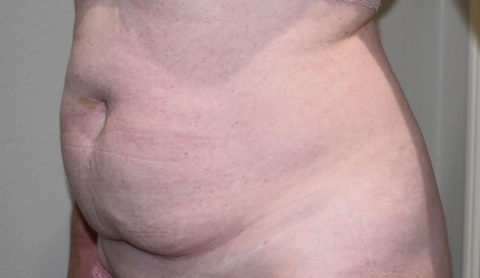 Tummy Tuck (Abdominoplasty): Case 316 - Before