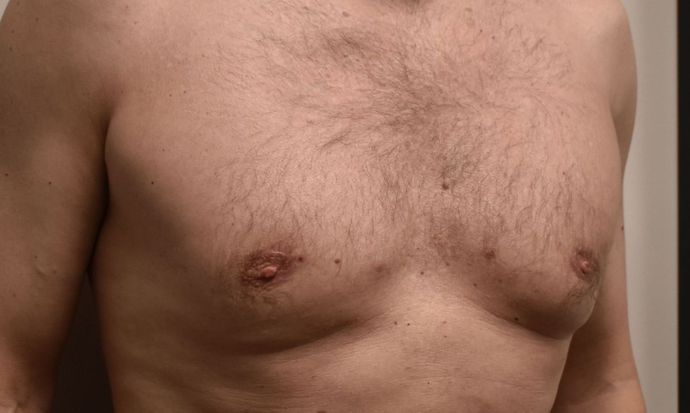 Gynecomastia: Case 4 - After