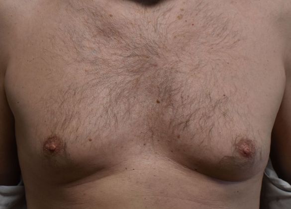 Gynecomastia Case 4 - Before
