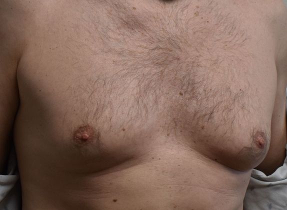 Gynecomastia: Case 4 - Before