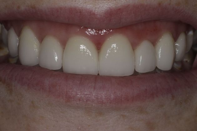 Cosmetic Dentistry Cosmetic Dentistry - Case 9 - After