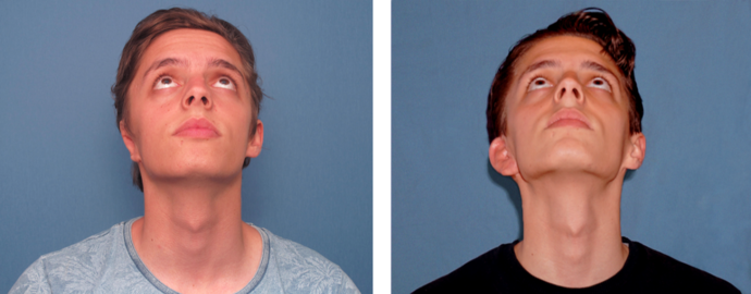 Correcting Prior Surgeries: Patient 3 - Before