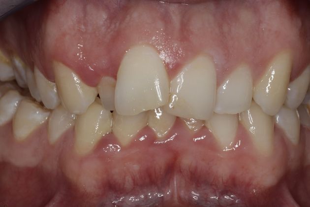 Invisalign: Case 4 - Before