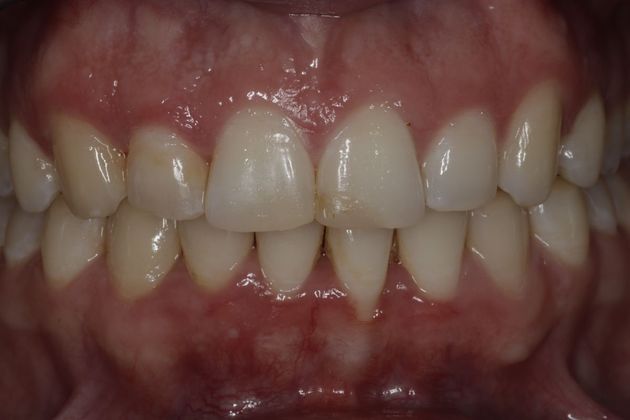 Invisalign: Case 4 - After