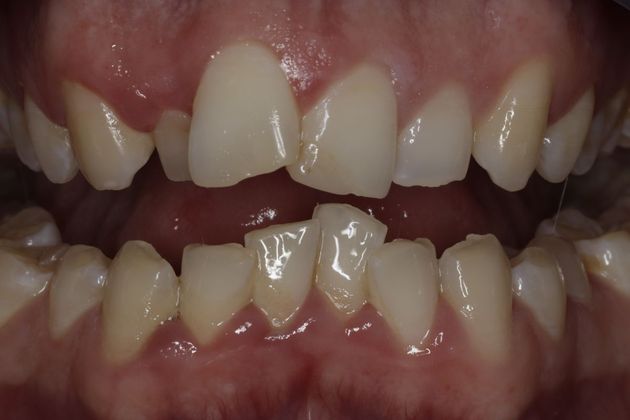 Invisalign Case 4 - Before