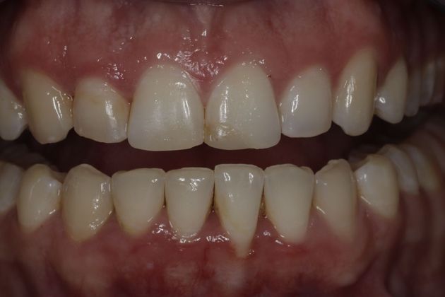 Invisalign Case 4 - After
