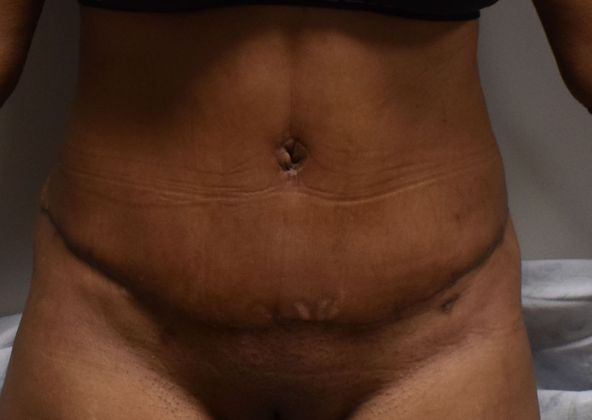 Tummy Tuck (Abdominoplasty): Case 317 - After