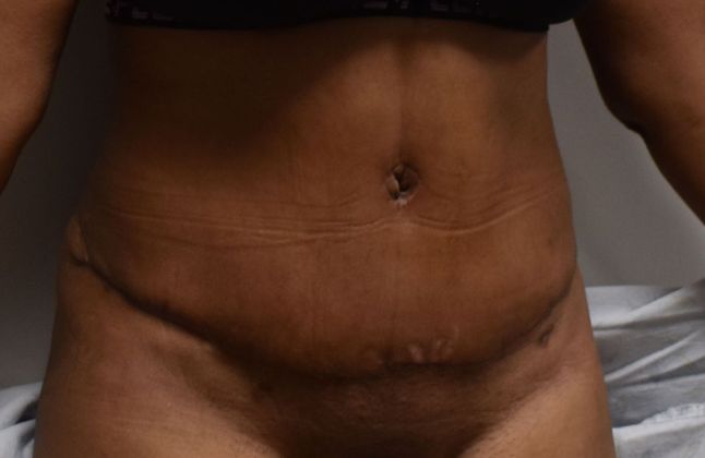 Tummy Tuck (Abdominoplasty): Case 317 - After