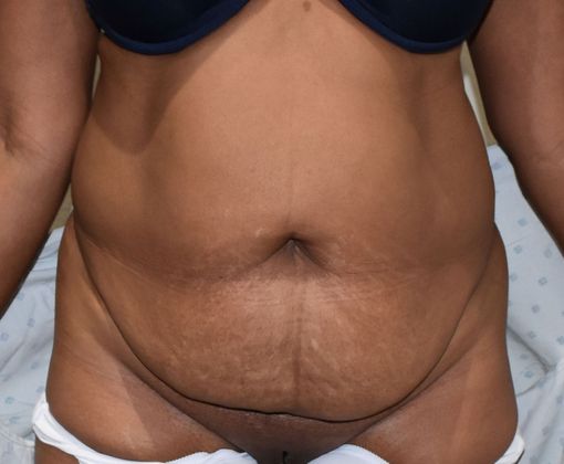 Tummy Tuck (Abdominoplasty): Case 317 - Before