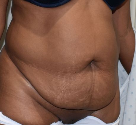 Tummy Tuck (Abdominoplasty): Case 317 - Before