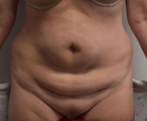 Tummy Tuck (Abdominoplasty): Case 318 - Before