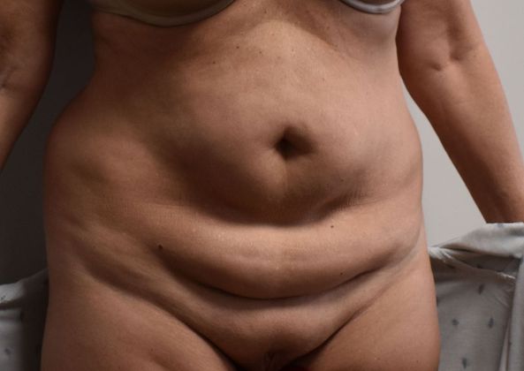 Tummy Tuck (Abdominoplasty): Case 318 - Before
