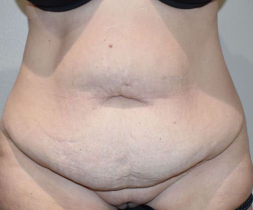 Tummy Tuck (Abdominoplasty): Case 319 - Before
