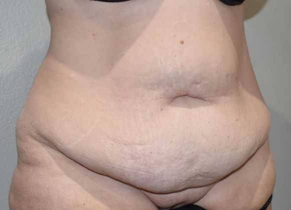Tummy Tuck (Abdominoplasty): Case 319 - Before