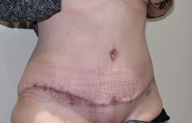 Tummy Tuck (Abdominoplasty): Case 319 - After