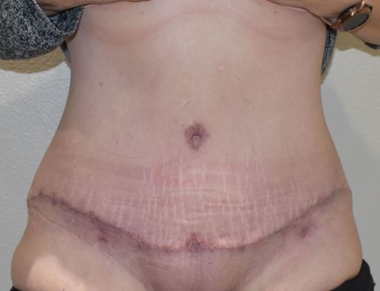 Tummy Tuck (Abdominoplasty): Case 319 - After